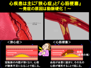 突然死する心臓血管病～家族を守るために何をすべきか～①